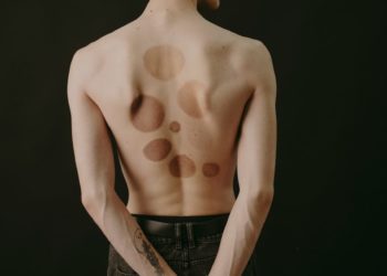 Vers un vaccin thérapeutique contre le cancer de la peau ?