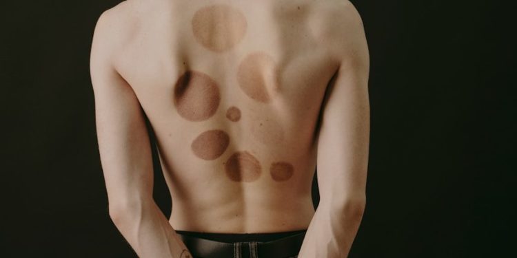 Vers un vaccin thérapeutique contre le cancer de la peau ?