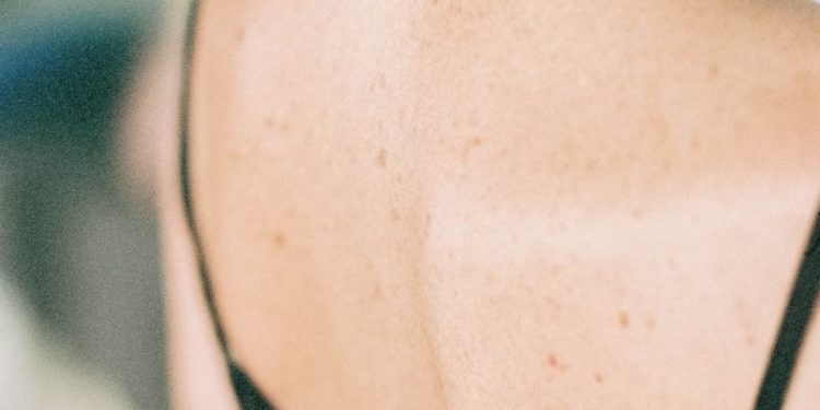 Les Kiné d'Occitanie mobilisés pour repérer les cancers de la peau