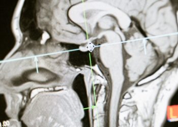 Alzheimer, ces premiers signes auxquels faire attention