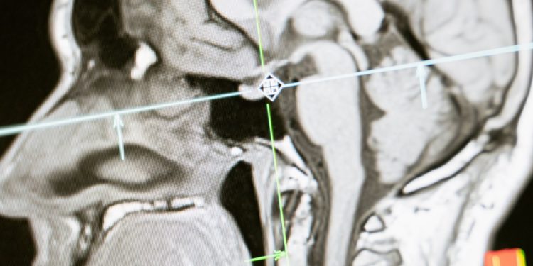 Alzheimer, ces premiers signes auxquels faire attention